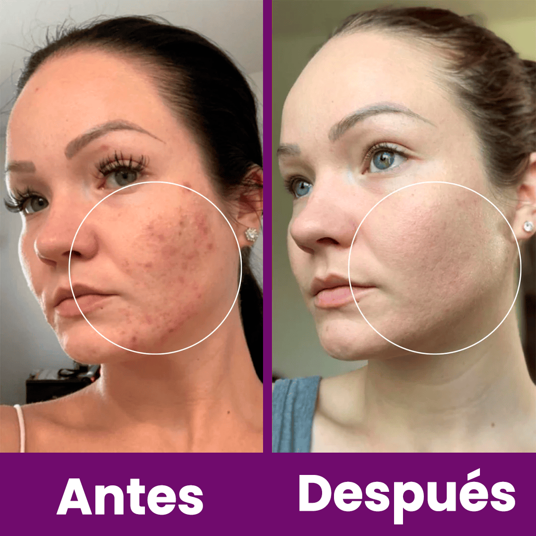 MÁQUINA FACIAL PROFESIONAL DE ALTA FRECUENCIA