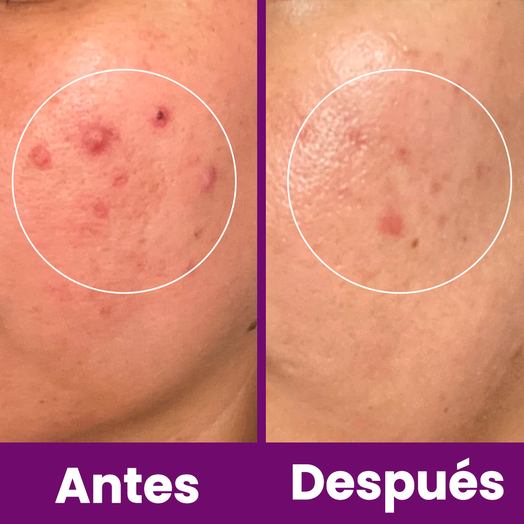 MÁQUINA FACIAL PROFESIONAL DE ALTA FRECUENCIA